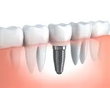Single Tooth Implant