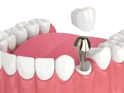 Tooth Build-Up